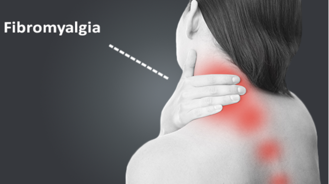Fibromyalgia graphic